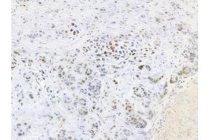 ABIN6256428 and ABIN6267317 at 1/100 staining human gastric carcinoma by IHC-P. (Retinoblastoma Protein (Rb) 抗体  (pSer807))