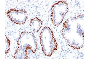 Formalin-fixed, paraffin-embedded human Prostate Cancer stained with p63 Rabbit Monoclonal Antibody (TP63/1423R). (p63 抗体)