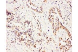 IHC-P: Eotaxin 3 antibody testing of human lung cancer tissue (CCL26 抗体  (AA 24-94))