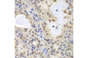 Immunohistochemistry of paraffin-embedded human oophoroma using MCM3 antibody (ABIN5970419) at dilution of 1/100 (40x lens). (MCM3 抗体)