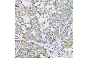 Immunohistochemistry of paraffin-embedded human liver cancer using COX6A1 antibody. (COX6A1 抗体)