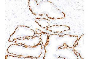 Formalin-fixed, paraffin-embedded human Prostate Carcinoma stained with Cytokeratin 14 Monoclonal Antibody (SPM263). (KRT14 抗体  (C-Term))