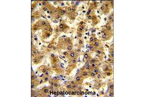 Formalin-fixed and paraffin-embedded human hepatocarcinoma reacted with ADH1B Antibody , which was peroxidase-conjugated to the secondary antibody, followed by DAB staining.