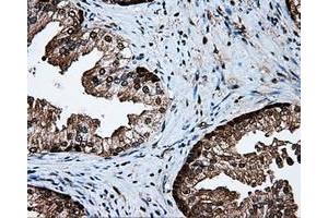Immunohistochemical staining of paraffin-embedded Carcinoma of liver tissue using anti-PSMC3 mouse monoclonal antibody. (PSMC3 抗体)
