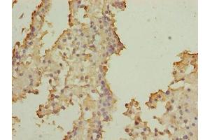 Immunohistochemistry of paraffin-embedded human breast cancer using ABIN7170508 at dilution of 1:100