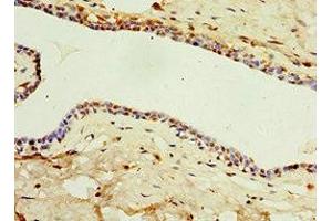 Immunohistochemistry of paraffin-embedded human breast cancer using ABIN7156854 at dilution of 1:100 (IL22 Receptor alpha 1 抗体  (AA 16-230))