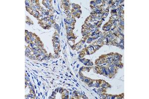 Immunohistochemistry of paraffin-embedded human gastric cancer using ATP5B antibody (ABIN5973391) at dilution of 1/100 (40x lens). (ATP5B 抗体)