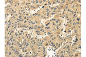 The image on the left is immunohistochemistry of paraffin-embedded Human liver cancer tissue using ABIN7130214(MED16 Antibody) at dilution 1/30, on the right is treated with fusion protein. (MED16 抗体)
