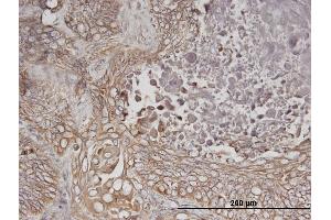 Immunoperoxidase of monoclonal antibody to ERBB3 on formalin-fixed paraffin-embedded human lung cancer. (ERBB3 抗体  (AA 1-130))