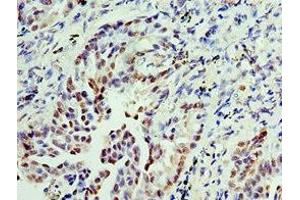 Immunohistochemistry of paraffin-embedded human lung cancer using ABIN7156290 at dilution of 1:100 (IMPDH2 抗体  (AA 215-514))