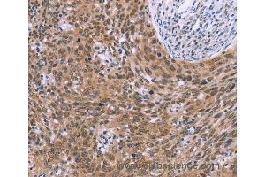 Immunohistochemistry of Human liver cancer using GLYR1 Polyclonal Antibody at dilution of 1:30 (GLYR1 抗体)