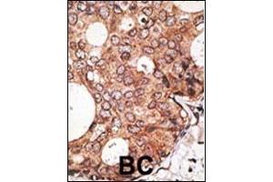 Formalin-fixed and paraffin-embedded human cancer tissue reacted with the primary antibody, which was peroxidase-conjugated to the secondary antibody, followed by AEC staining. (MAGEA10 抗体  (C-Term))