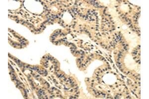 The image on the left is immunohistochemistry of paraffin-embedded Human thyroid cancer tissue using ABIN7130214(MED16 Antibody) at dilution 1/30, on the right is treated with fusion protein. (MED16 抗体)