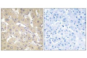 Immunohistochemistry analysis of paraffin-embedded human liver carcinoma tissue, using TNAP2 antibody. (TNFAIP2 抗体  (Internal Region))
