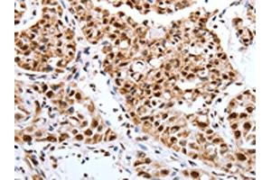 The image on the left is immunohistochemistry of paraffin-embedded Human lung cancer tissue using ABIN7193127(Map2 Antibody) at dilution 1/40, on the right is treated with synthetic peptide. (MAP2 抗体)