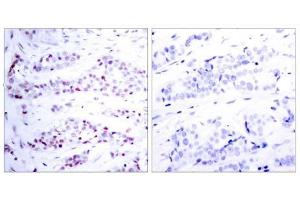 Immunohistochemical analysis of paraffin-embedded human breast carcinoma tissue using STAT6 (Ab-641) antibody (E021050). (STAT6 抗体)