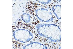 Immunohistochemistry of paraffin-embedded human colon using CD45 Rabbit pAb (ABIN3022953, ABIN3022954, ABIN3022955, ABIN1513451 and ABIN6219315) at dilution of 1:50 (40x lens). (CD45 抗体  (AA 890-990))