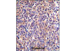 THEMIS Antibody immunohistochemistry analysis in formalin fixed and paraffin embedded human thymoma followed by peroxidase conjugation of the secondary antibody and DAB staining. (THEMIS 抗体  (C-Term))