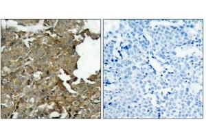 Immunohistochemical analysis of paraffin-embedded human breast carcinoma tissue using cofilin(Ab-3) Antibody(left) or the same antibody preincubated with blocking peptide(right). (Cofilin 抗体  (AA 1-5))