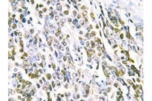 Immunohistochemistry analyzes of MRE11 antibody in paraffin-embedded human lung carcinoma tissue. (Mre11 抗体)