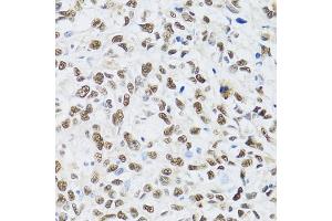 Immunohistochemistry of paraffin-embedded human liver cancer using MT antibody (ABIN6128251, ABIN6144117, ABIN6144118 and ABIN6222360) at dilution of 1:100 (40x lens). (MTA3 抗体  (AA 40-330))