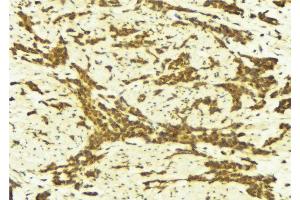 ABIN6269248 at 1/100 staining Human breast cancer tissue by IHC-P. (STAT5A 抗体  (C-Term))