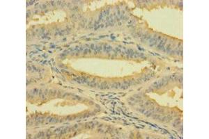 Immunohistochemistry of paraffin-embedded human endometrial cancer using ABIN7142784 at dilution of 1:100 (RPL26L1 抗体  (AA 1-145))