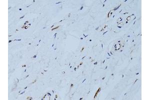 Immunohistochemistry of paraffin-embedded human breast using SELE Antibody (ABIN5971217) at dilution of 1/100 (40x lens). (Selectin E/CD62e 抗体)