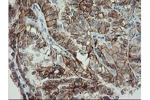 Immunohistochemical staining of paraffin-embedded Adenocarcinoma of Human ovary tissue using anti-CDH2 mouse monoclonal antibody. (N-Cadherin 抗体)