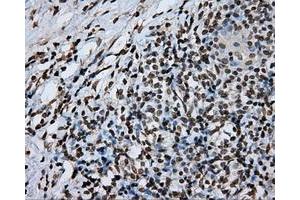 Immunohistochemical staining of paraffin-embedded Adenocarcinoma of ovary tissue using anti-DAPK2 mouse monoclonal antibody. (DAPK2 抗体)