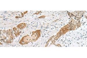 Immunohistochemistry of paraffin-embedded Human esophagus cancer tissue using HIST1H2BK Polyclonal Antibody at dilution of 1:40(x200) (HIST1H2BK 抗体)
