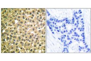 Immunohistochemical analysis of paraffin-embedded human breast carcinoma tissue using Retinoic Acid Receptor beta antibody (ABIN5976499).