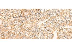 Immunohistochemistry of paraffin-embedded Human gastric cancer tissue using KRT9 Polyclonal Antibody at dilution of 1:30(x200) (KRT9 抗体)