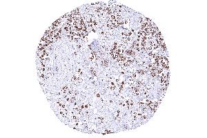 Invasive lobular breast cancer with strong cytoplasmic ATP5J staining of all tumor cells
