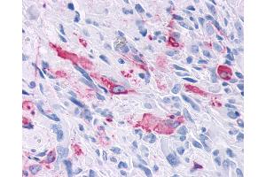 Anti-MRGD / MRGPRD antibody IHC of human Brain, Glioblastoma. (MRGPRD 抗体  (Cytoplasmic Domain))