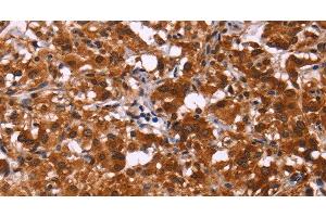 Immunohistochemistry of paraffin-embedded Human thyroid cancer tissue using ART5 Polyclonal Antibody at dilution 1:50 (ART5 抗体)