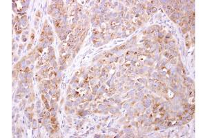 IHC-P Image ETNK1 antibody [N2C3] detects ETNK1 protein at cytosol on H358 xenograft by immunohistochemical analysis. (Ethanolamine Kinase 1 抗体)