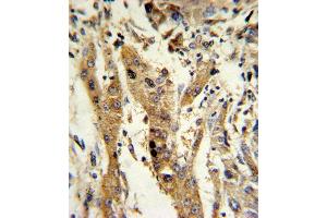 Formalin-fixed and paraffin-embedded human hepatocarcinoma reacted with GSTM1 Antibody (C-term), which was peroxidase-conjugated to the secondary antibody, followed by DAB staining. (GSTM1 抗体  (C-Term))