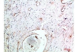 Immunohistochemical analysis of paraffin-embedded human-cervical-cancer, antibody was diluted at 1:200 (TNIP2 抗体  (AA 61-110))