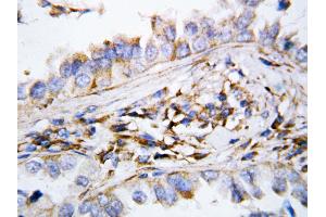 Anti-MIG antibody, IHC(P) IHC(P): Human Lung Cancer Tissue (CXCL9 抗体  (N-Term))