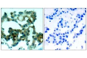 Immunohistochemical analysis of paraffin-embedded human lung carcinoma tissue, using PKCβ (Ab-641) antibody (E021184). (PKC beta 抗体)