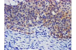 Immunohistochemical staining of paraffin-embedded Adenocarcinoma of Human ovary tissue using anti-PLDN mouse monoclonal antibody. (Pallidin 抗体)