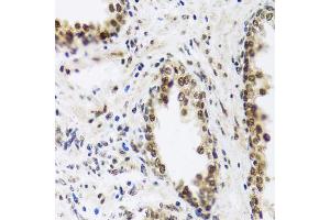 Immunohistochemistry of paraffin-embedded human prostate using SAFB2 antibody (ABIN5972429) at dilution of 1/100 (40x lens). (SAFB2 抗体)