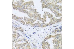 Immunohistochemistry of paraffin-embedded human liver cancer using TIMM10B antibody at dilution of 1:100 (x40 lens). (TIMM10B 抗体)