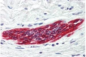 Human Breast (formalin-fixed, paraffin-embedded) stained with DAPK2 antibody ABIN214481 at 5 ug/ml followed by biotinylated goat anti-rabbit IgG secondary antibody ABIN481713, alkaline phosphatase-streptavidin and chromogen. (DAPK2 抗体  (C-Term))