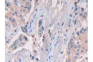 Detection of CD74 in Human Breast cancer Tissue using Polyclonal Antibody to Cluster Of Differentiation 74 (CD74) (CD74 抗体  (AA 78-222))