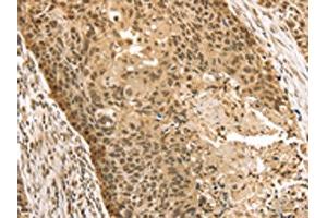 The image on the left is immunohistochemistry of paraffin-embedded Human esophagus cancer tissue using ABIN7131203(STAG2 Antibody) at dilution 1/35, on the right is treated with fusion protein. (STAG2 抗体)
