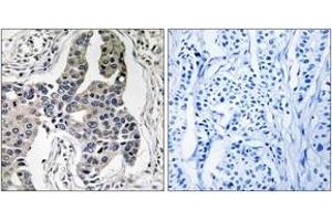 Immunohistochemistry analysis of paraffin-embedded human breast carcinoma, using Vimentin (Phospho-Ser83) Antibody. (Vimentin 抗体  (pSer83))