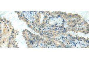Immunohistochemistry of paraffin-embedded Human thyroid cancer tissue using CTDP1 Polyclonal Antibody at dilution of 1:55(x200) (CTDP1 抗体)
