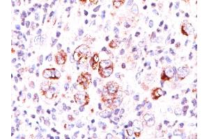 Formalin-fixed, paraffin-embedded Hodgkin's lymphoma stained with Bcl-x Mouse Monoclonal Antibody (2H12). (BCL2L1 抗体  (AA 3-14))